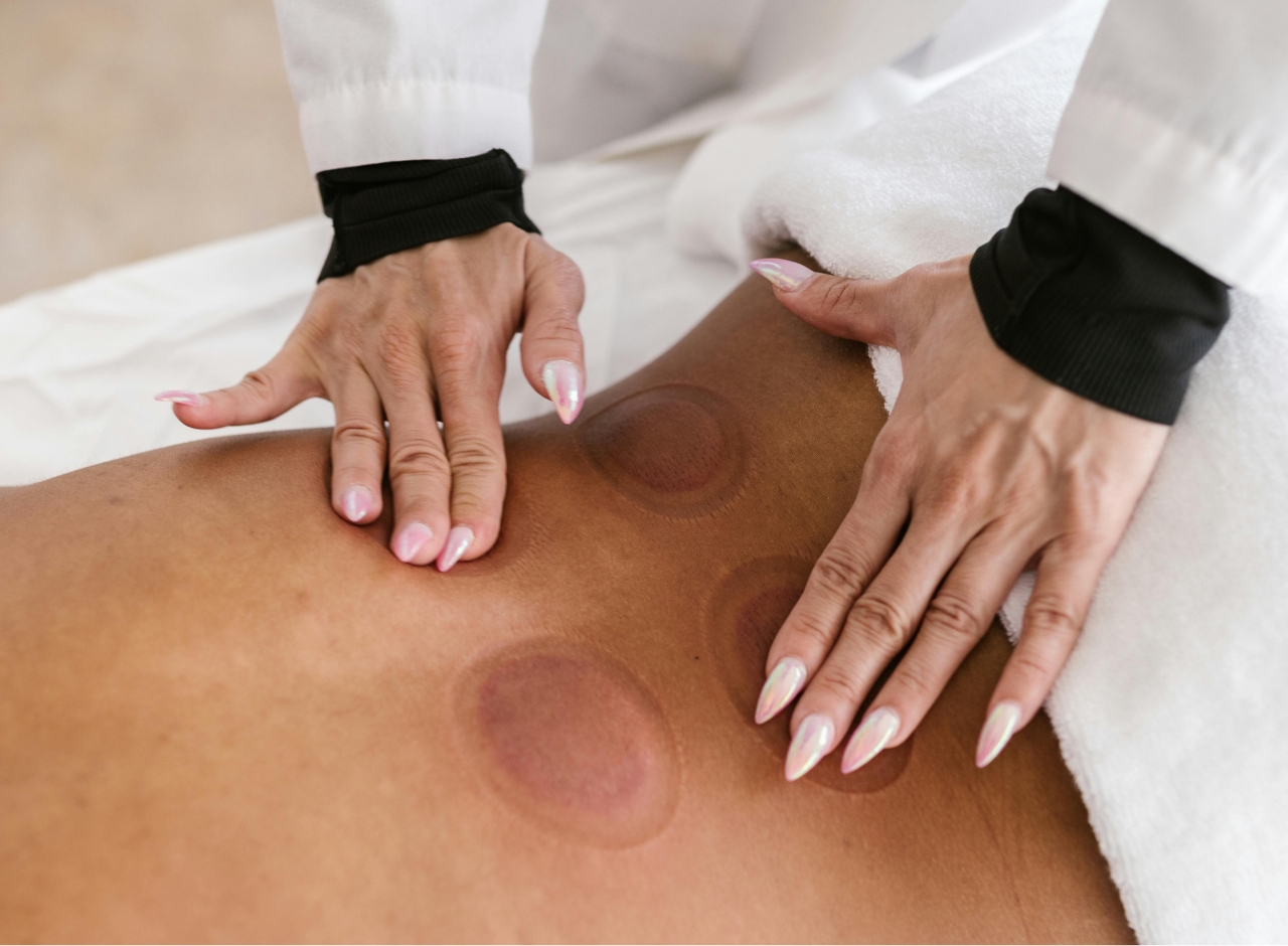 Individualized acupuncture and cupping therapy from Health by Hamdon, St. Albert