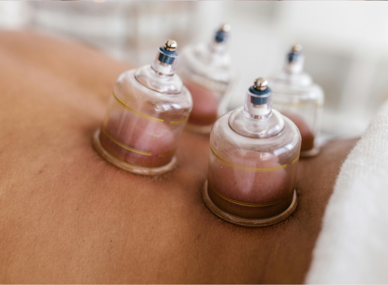 St. Albert cupping and acupuncture treatments